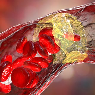 Cardiovascular Atherosclerosis 2026: Prediction, Prevention and Management Banner
